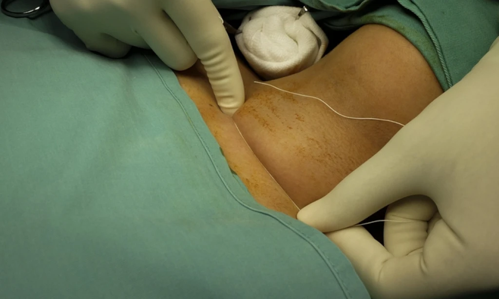 Prosedur Operasi & Estimasi Biaya Operasi Tiroid